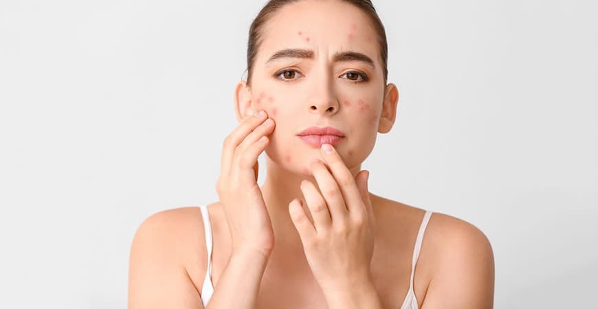 روش‌های درمانی کاهش جوش و آکنه